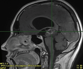 Tumeur rare de la r�gion pin�ale