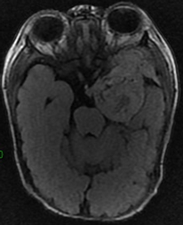 Une dr�le de tumeur