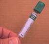 Dur�e d'un traitement anticoagulant&nbsp;: l�int�r�t des D-Dim�res