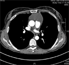 Une fatigue difficile � d�finir