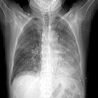 Une pneumonie subaigu�