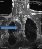 Une tumeur de la paroi thoracique