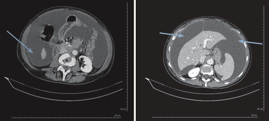 Suppression par le catumaxomab d�une ascite invalidante chez une patiente souffrant d�une carcinose p�riton�ale li�e � un cancer de l�ovaire
