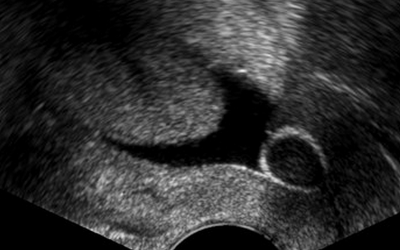 Hyst�rosonographie, hyst�roscopie, la fin du Gold Standard&nbsp;?