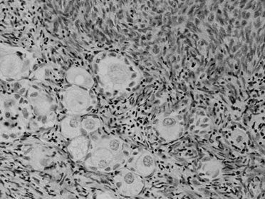 Protocole combin� de pr�servation de la fertilit� associant vitrification d�ovocytes apr�s maturation in vitro et cryoconservation de tissu ovarien avant et apr�s traitement chez des jeunes patientes atteintes de cancers