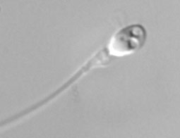 L�IMSI (Intra-cytoplasmic morphologically selected sperm injection) n�am�liore pas les r�sultats en 3�me tentative d�AMP apr�s 2 �checs pr�alables d�ICSI conventionnelle