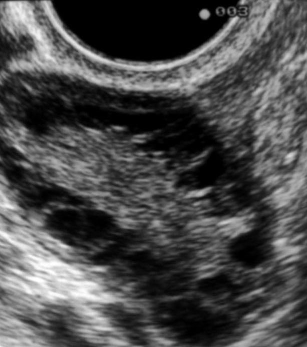 Importance relative des modifications des taux d�AMH et d�androg�nes avec l��ge chez les femmes avec SOPK, de poids normal
