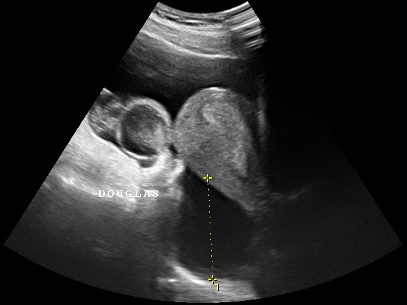 Un traitement court par metformine ne r�duit pas le risque d'hyperstimulation ovarienne au cours d'un cycle antagoniste chez les femmes ayant un syndrome des ovaires polykystiques&nbsp;: une �tude randomis�e-contr�l�e contre placebo