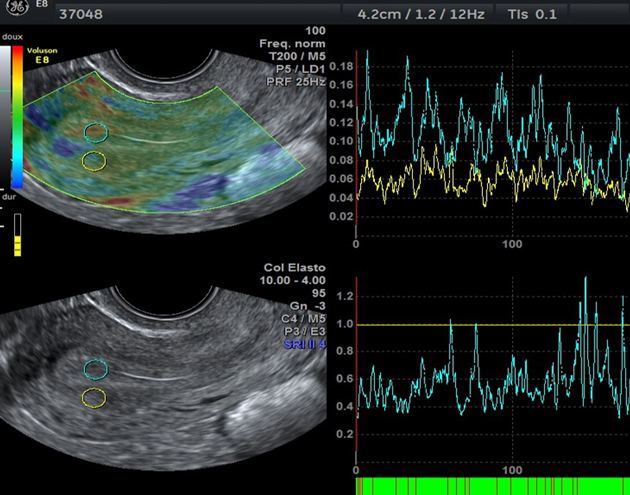 Contractilit� ut�rine et �lastographie, facteurs pronostiques en ins�mination intra-ut�rine