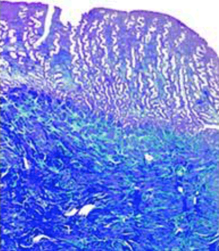 Le � scratch � endom�trial avant ins�mination intra-ut�rine&nbsp;: est-ce le moment de r��valuer son int�r�t&nbsp;? Quelle �vidence apport�e par une revue syst�matique et m�ta-analyse d'essais randomis�s&nbsp;?