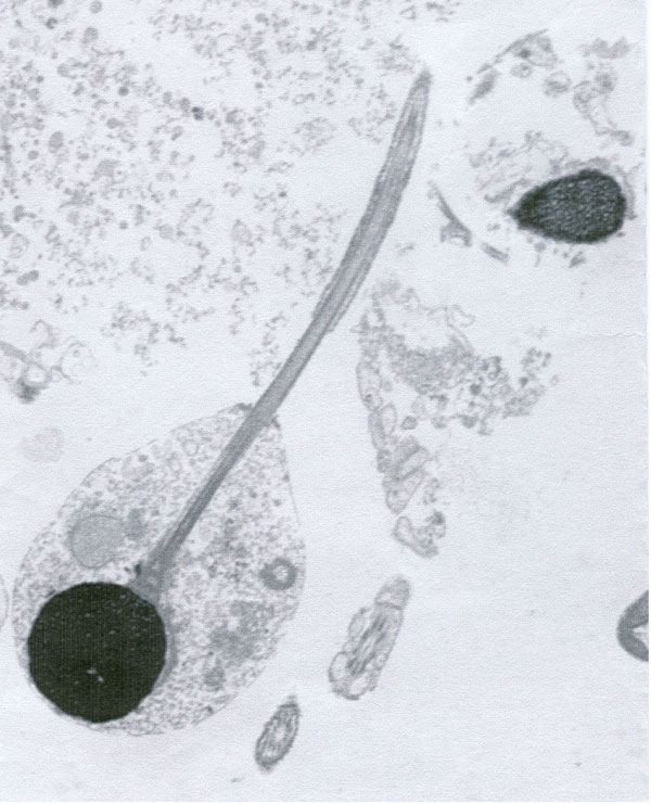 Meilleur taux de grossesse en utilisant le sperme testiculaire chez les hommes pr�sentant une oligospermie s�v�re