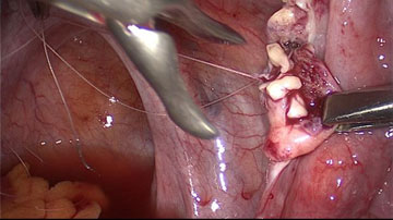 Optimisation des r�sultats de la cryoconservation de tissu ovarien et de la transplantation&nbsp;; activation versus pr�servation