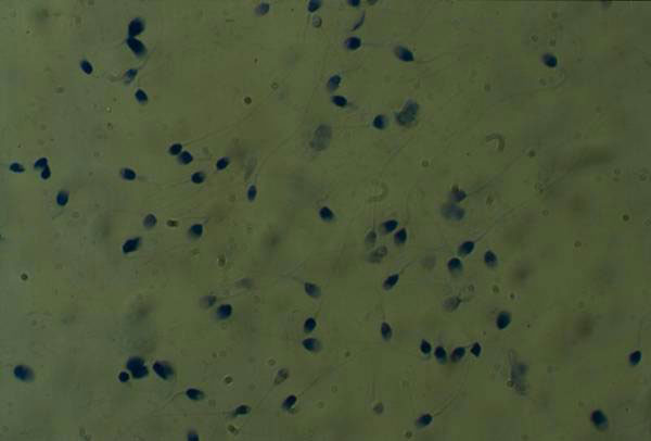 Une m�thylation anormale de l�ADN spermatique pr�dit la fertilit� d�un homme et la qualit� embryonnaire