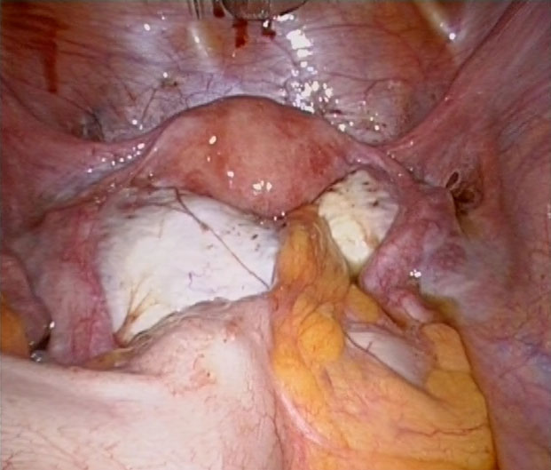 Traitement de l�infertilit� associ�e � une endom�triose profonde&nbsp;: d�finition et strat�gie th�rapeutique