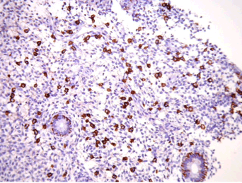 Taux de naissances vivantes apr�s antibioth�rapie orale pour endom�trite chronique chez des femmes aux ant�c�dents d'�checs d'implantation r�p�t�s