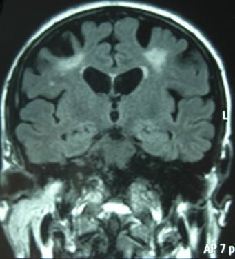Le syndrome de Sneddon&nbsp;: savoir d�shabiller les malades&nbsp;!