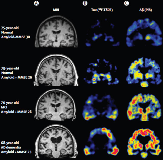 A la recherche des tauopathies&nbsp;: une nouvelle fronti�re pour biologistes et imageurs