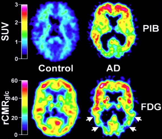 Le recours aux biomarqueurs dans le diagnostic de la maladie d�Alzheimer pour am�liorer la pr�cocit� et la fiabilit� du diagnostic