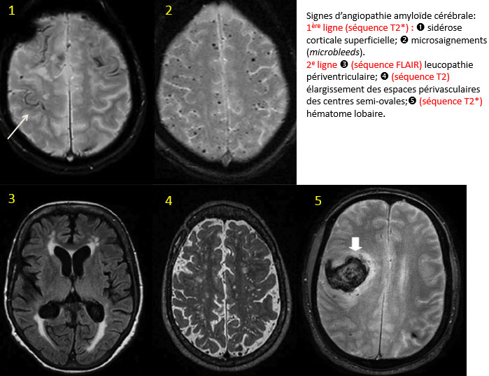 Un peu de neuf dans les angiopathies amylo�des c�r�brales