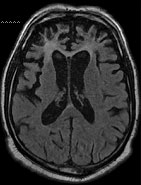 Les d�g�n�rescences lobaires fronto-temporales (DLFT). Syndromes et crit�res cliniques, le point sur la question
