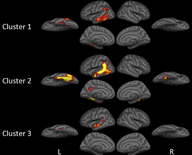 L'aphasie logop�nique est-elle une entit� unitaire&nbsp;?