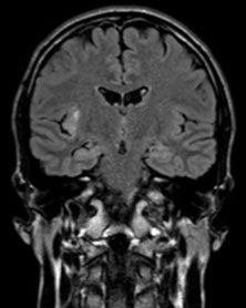 Vers l�insula et au-del�&nbsp;! Trois cas cliniques