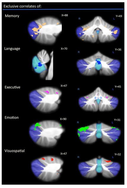 Le cervelet&nbsp;: terra incognita des d�mences&nbsp;?
