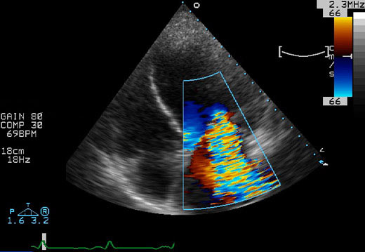 Insuffisance mitrale importante - Chirurgie, anneau mitral percutan�, clip mitral ou resynchronisation cardiaque&nbsp;?