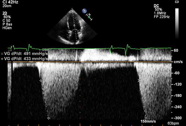 dP/dt&nbsp;: toujours d�actualit� pour �valuer les pressions de remplissage VG&nbsp;?