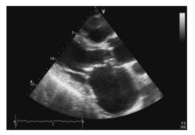 R�tr�cissement mitral d�origine rhumatismale chez une patiente de 48 ans