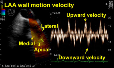 Doppler tissulaire de l�auricule gauche et risque de r�currence d�une fibrillation atriale non paroxystique apr�s ablation par cath�ter