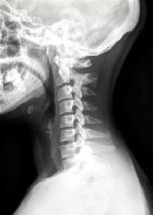 Un diagnostic souvent �voqu� mais rarement retrouv�