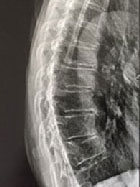 Quand la cascade fracturaire est trop rapide pour consulter le rhumatologue