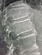 Rachialgie et raideur