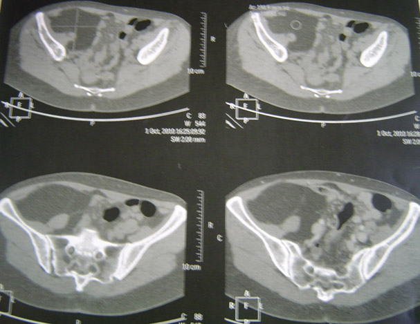 Des difficult�s � fl�chir la cuisse