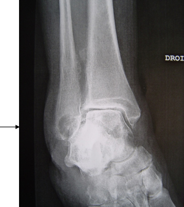 G�ode osseuse ou non