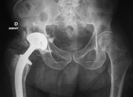 Une raideur post op�ratoire