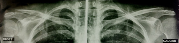 Une douleur de l��paule