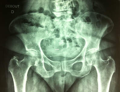 Attention � toutes les chutes