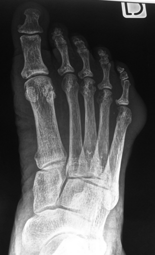 Des tum�factions des pieds