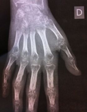 Attention aux chutes en v�lo