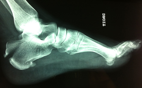 Du m�canisme de la chute au diagnostic