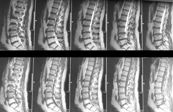 Apr�s le cancer, l�os