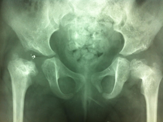 Une longue histoire de hanches