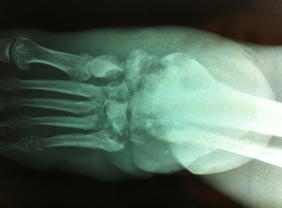 Une redoutable infection