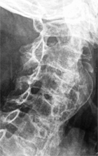 Un signe clinique projet�