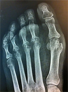 Anti-CCP marqueur osseux&nbsp;?