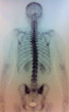 La dorsalgie est de diagnostic d�licat