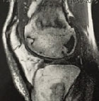 Une image osseuse symptomatique&nbsp;?