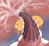 Les stents actifs, r�serv�s � quelques situations cliniques